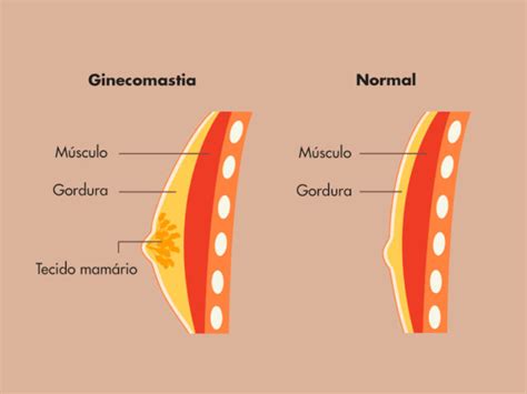 Ginecomastia O Guia Definitivo Da Cirurgia Dream Plastic