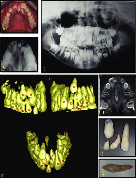 A Occlusal View Showing Abnormal Supernumerary Teeth In The Anterior Download Scientific