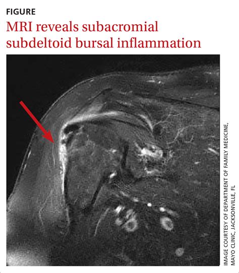 Subacromial Bursitis MRI