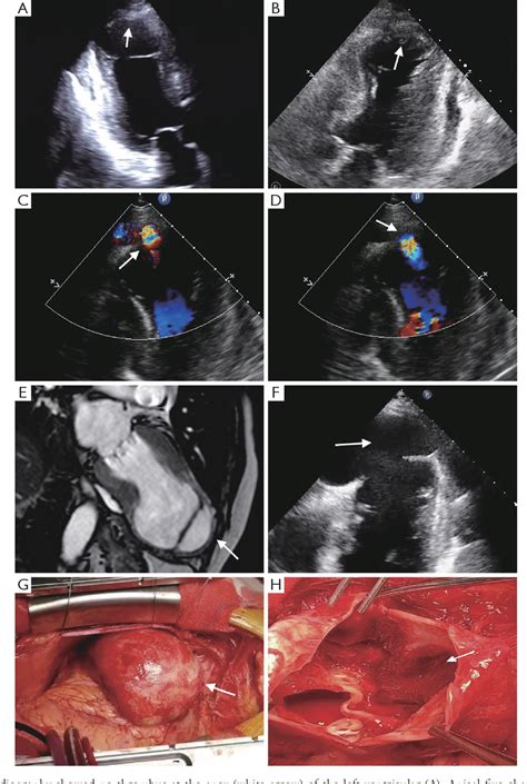 Figure 1 From Progressive Intramyocardial Dissecting Hematoma In The