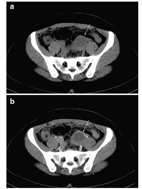 A And B Ct Radiographs Of The Same Patient With Plain And Enhanced