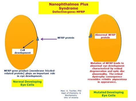 nanophthalmos  syndrome hereditary ocular diseases