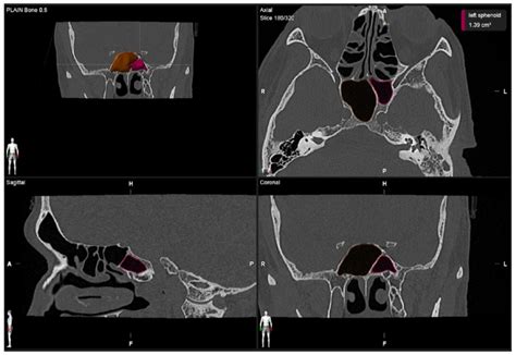 Volumetric Measurement Of The Right And Left Sphenoid Sinus Download Scientific Diagram