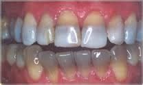 How Tetracycline Causes Permanent Teeth Stains – Flexidentist