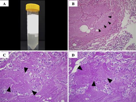 Figure2appearance Of Bronchoalveolar Lavage Fluid And Pathological