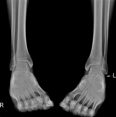 Filepilon Fracture Bilateral Radiopaedia 52423 58335 Oblique 1jpeg