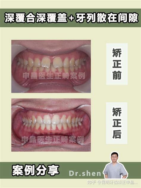 昆明牙齿矫正昆明正畸不拔牙矫正深覆合深覆盖牙齿散在间隙 知乎