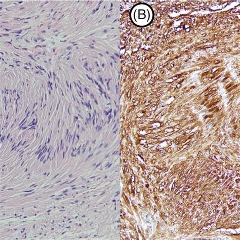 A The Tumour Was Composed Of Interlacing Bundles Of Spindle Cells