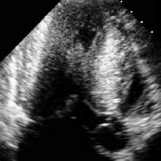 Systolic anterior motion (SAM) of the mitral valve visualized by M-Mode ...