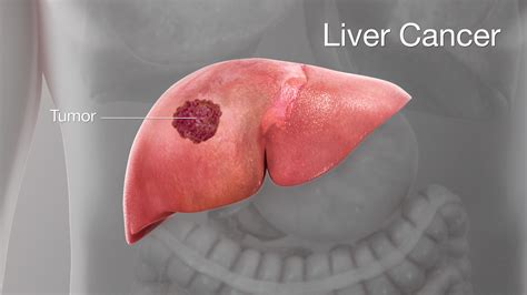 Liver Cancer Symptoms Causes Diagnosis Treatment And Prevention