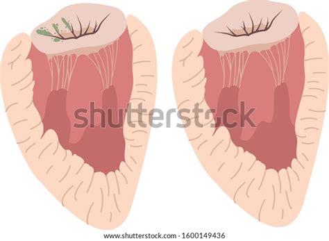 Papillary Muscles Chordae Tendinea Images Stock Photos Vectors