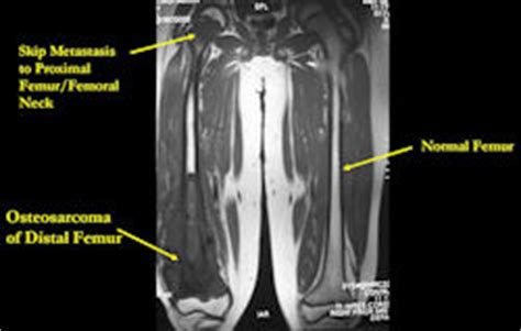 Tumor On Femur Bone Adult