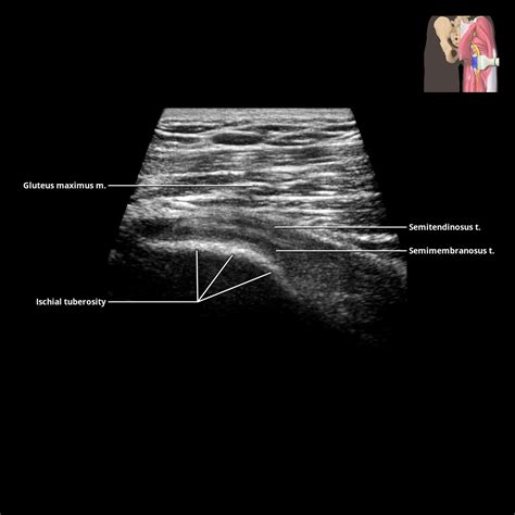 Gluteal Muscles Radiology Key