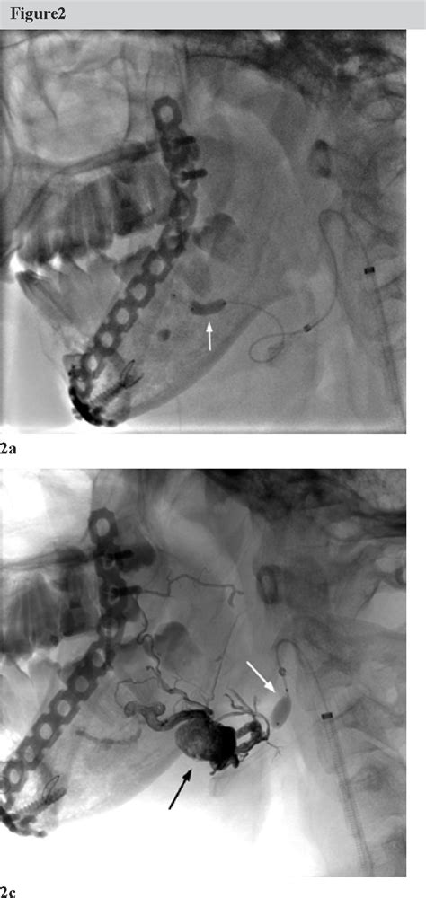 figure   balloon assisted onyx embolization   extensive