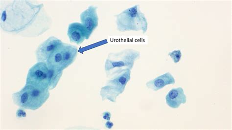 Urothelial cells | MyPathologyReport.ca