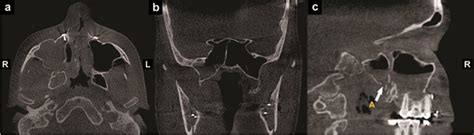 Scielo Brasil Implications Of Anatomical Variation Of The Sphenoid