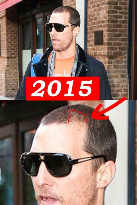 Matthew McConaughey Hair Loss Secrets Revealed!