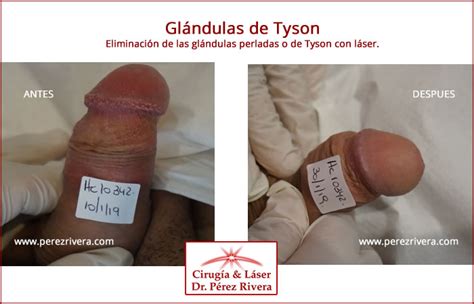 Eliminaci N Gl Ndulas De Tyson Eliminaci N P Pulas Perladas En Pene