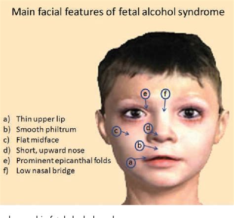 Fetal Alcohol Spectrum Disorders And Abnormal Neuronal Plasticity