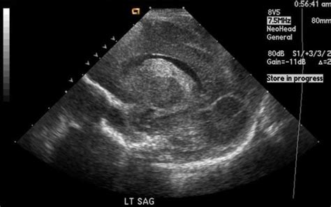 Germinal Matrix Hemorrhage Radiology Case