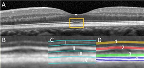 Approaches To Segmenting The Four Outer Retinal Hyperreflective Bands