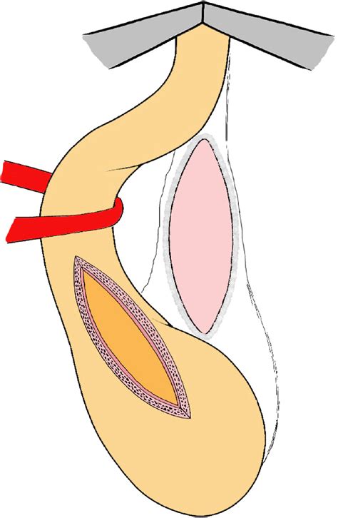 Bulbar Urethroplasty With Dorsal Onlay Buccal Mucosal Graft And Fibrin