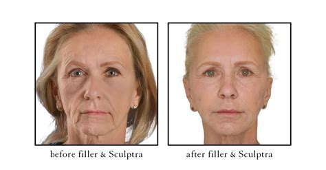 Botox Before And After Photos Before And Afters Gallery Cslc