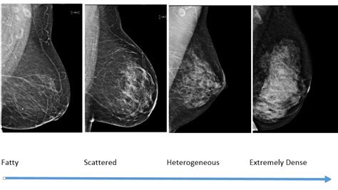 What Does Breast Cancer Look Like On An Ultrasound