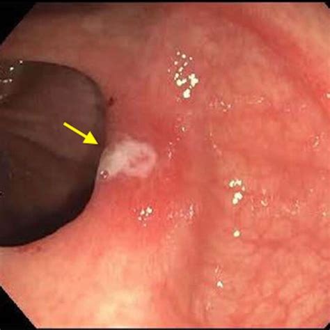 Colonoscopy Image Pointing To 6 Mm Ulcerated Lesion In The Cecum 6 Download Scientific Diagram