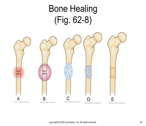 Bone Healing Diagram | Quizlet