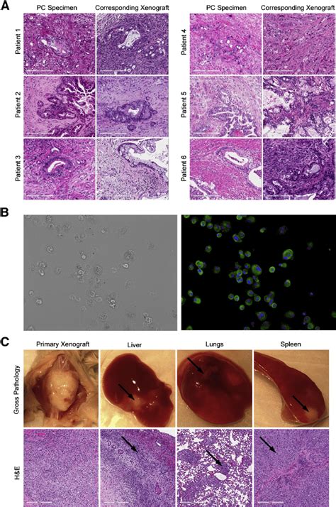 Patient Derived Pancreatic Cancer Pc Xenografts Retain Tumor