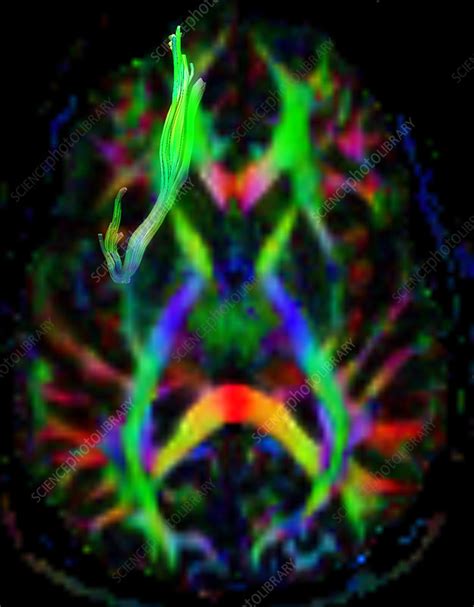 Uncinate Fasciculus, DTI - Stock Image - C036/6134 - Science Photo Library