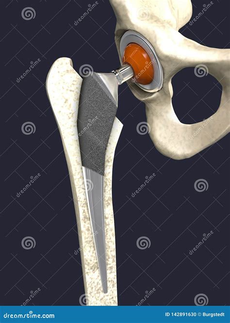 Function Of A Hip Joint Implant Or Hip Prosthesis In Frontal View Stock