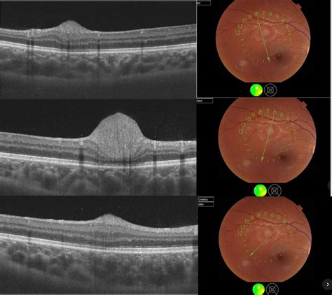 OCT scans and fundus photography showing Lesion 2. Top: the OCT scan... | Download Scientific ...