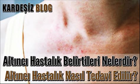 Alt Nc Hastal K Belirtileri Nelerdir Alt Nc Hastal K Nas L Tedavi