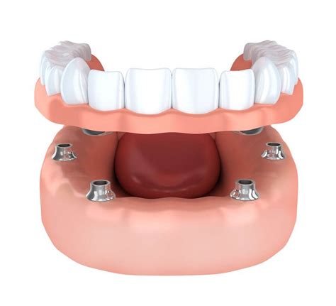 Implant Retained Overdentures The Aubrey Dentist