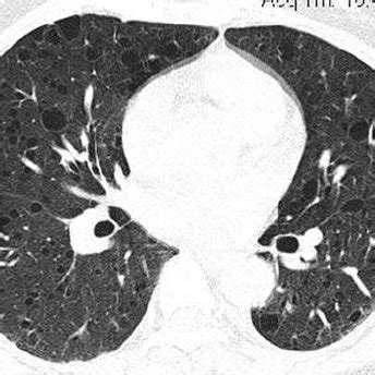 Intralobar pulmonary sequestration. CT scan showing calcified mass in ...