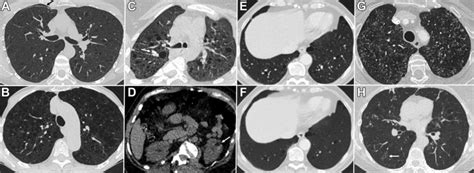 Diffuse Cystic Lung Disease Chest