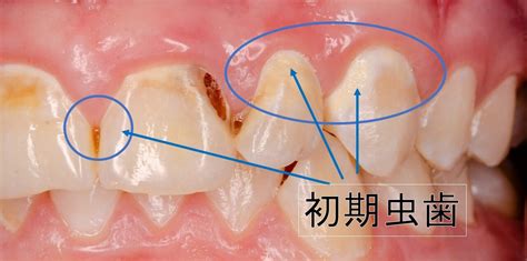 初期虫歯とは？症状と検査、治療法を解説 西田辺阿倍野区の歯医者 歯周病｜西田辺えがしら歯科