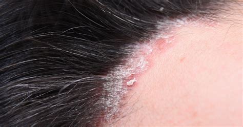 Can Psoriasis Cause Hair Loss? | RHRLI