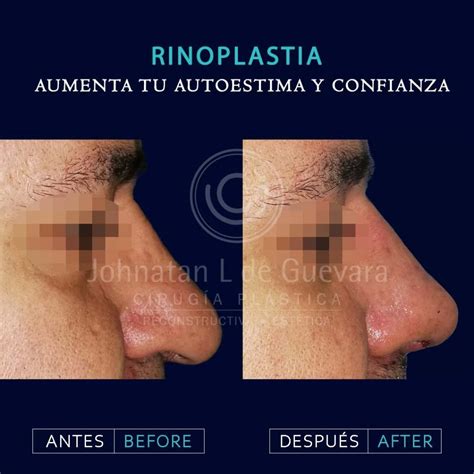 Mentoplastia C Mo Funciona Este Procedimiento De Cirug A Est Tica Facial