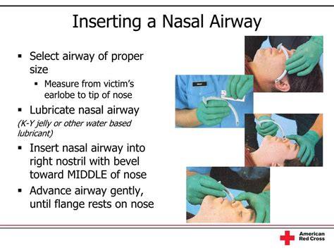 Nasopharyngeal Airway Size Chart