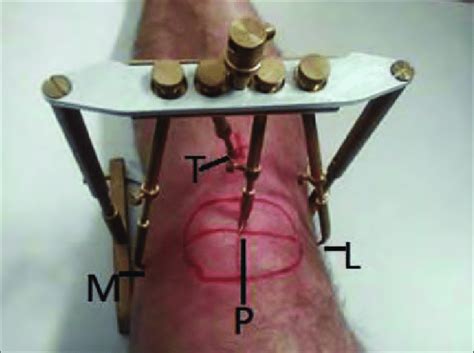 Measurement Of The Knee S Anatomic Points P Centre Of Patella T