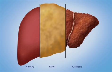 Healthy Fatty And Cirrhotic Liver Poster Print By Monica Schroeder