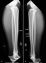 Fronteras Fracturas Bilaterales Concurrentes De La Tibia Anterior Por