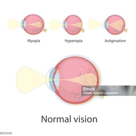 eye defects stock illustration  image  astigmatism