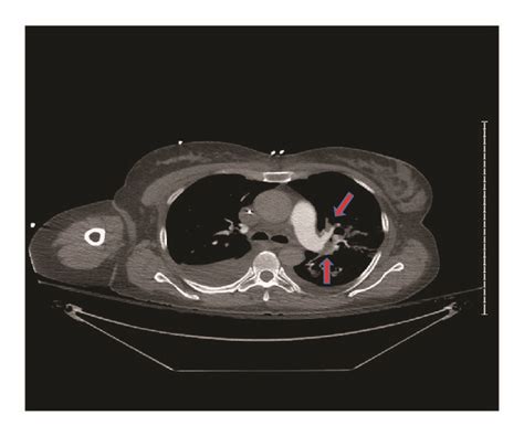 Ct Angiogram Showing Pulmonary Embolism Arrow Download Scientific Diagram