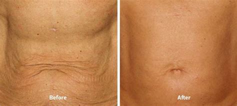 Thermage Philadelphia Skin Tightening Laser Skin Tightening Skin