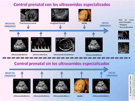 Translucencia Nucal Ultrasonido Fetal Especializado Saltillo