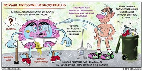 Normal Pressure Hydrocephalus Medizzy